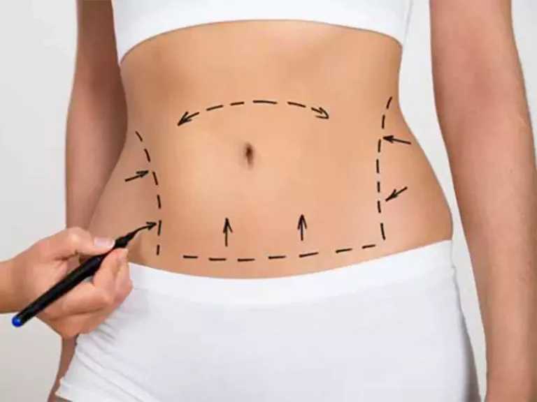 abdominoplasty