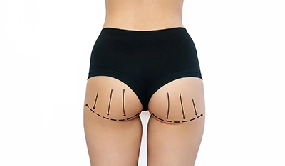 پروتز باسن در ایران