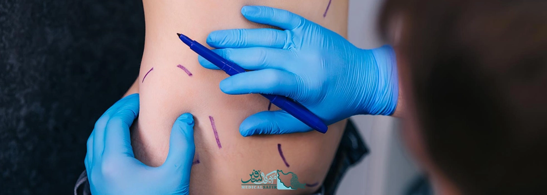 ابدومینوپلاستی در ارومیه