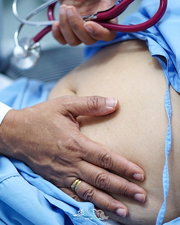 اسلیو معده در ایران