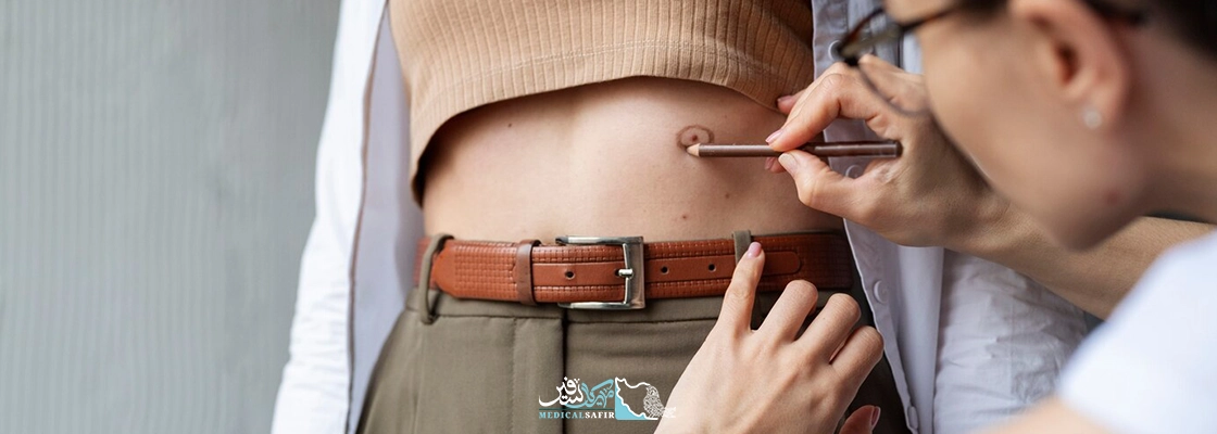 اسلیو معده در ایران