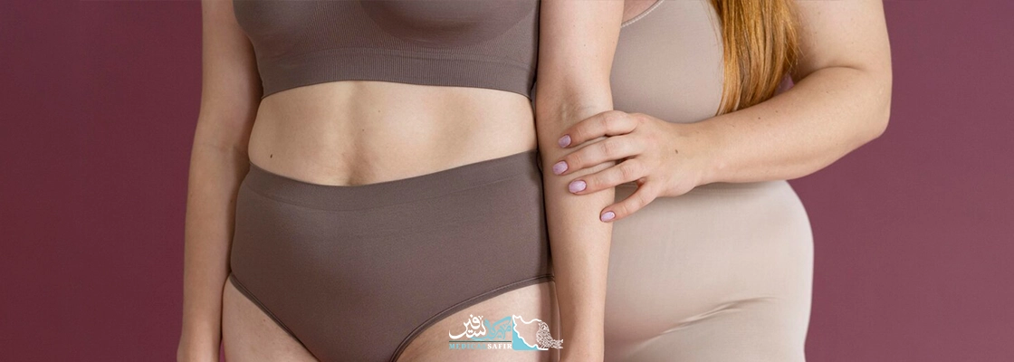 اسلیو معده در ایران