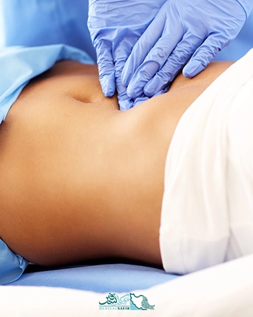 اسلیو معده در ایران