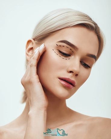 بلفاروپلاستی در ایران