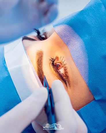 جراحی چشم گربه ای