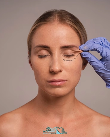 جراحی چشم گربه ای