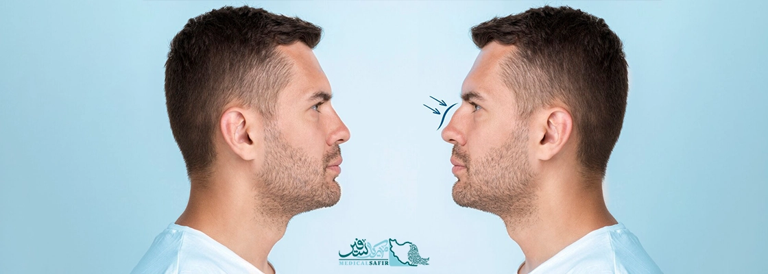 رینوپلاستی در ایران