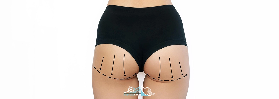 پروتز باسن در ایران