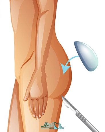 پروتز باسن در ایران