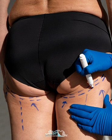 پروتز باسن در ایران