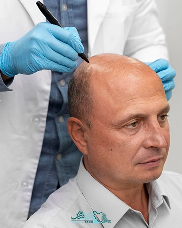 کاشت مو در ایران