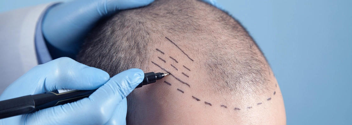 کاشت مو در ایران