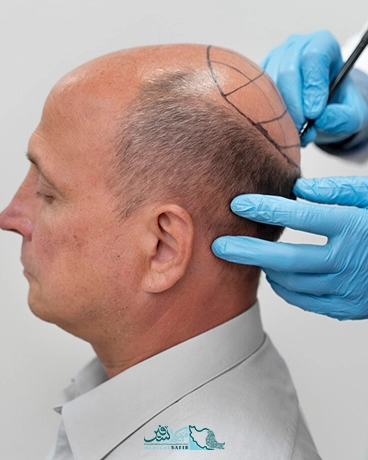 کاشت مو در ایران